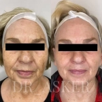 Collagen+ Akvavita | Рекомбинантный коллаген III типа