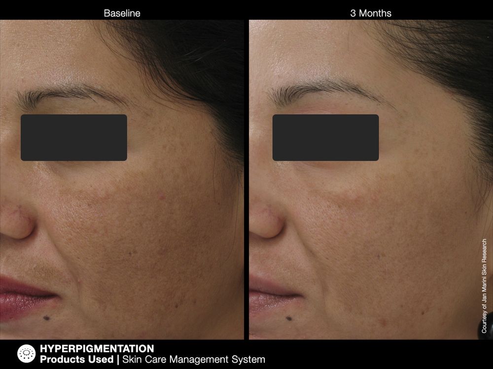 JAN MARINI SKIN CARE MANAGEMENT SYSTEM (NORMAL-COMBO) SPF33