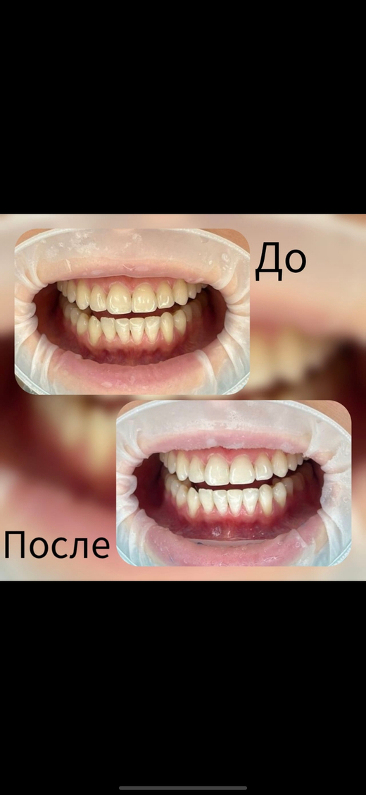 Отбеливание