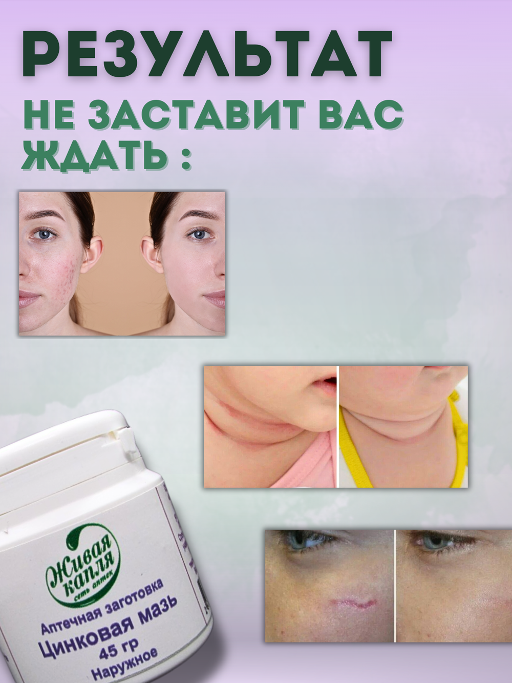 ЦИНКОВАЯ МАЗЬ 10% 45 г