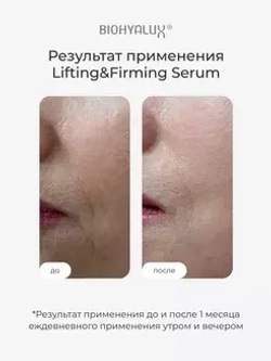 Сыворотка с гиалуроновой кислотой для повышения упругости и лифтинга кожи | BIOHYALUX HА LIFTING&FIRMING SERUM 30х1,5 мл