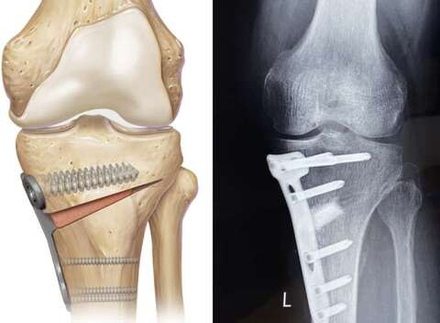 Остеотомия большеберцовой кости