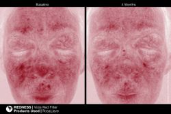 JAN MARINI ROSALIEVE Крем-акселератор для комплексного решения проблем розацеа