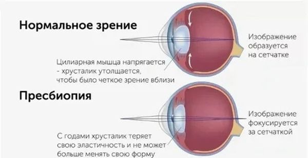 Современные решения для возрастного зрения