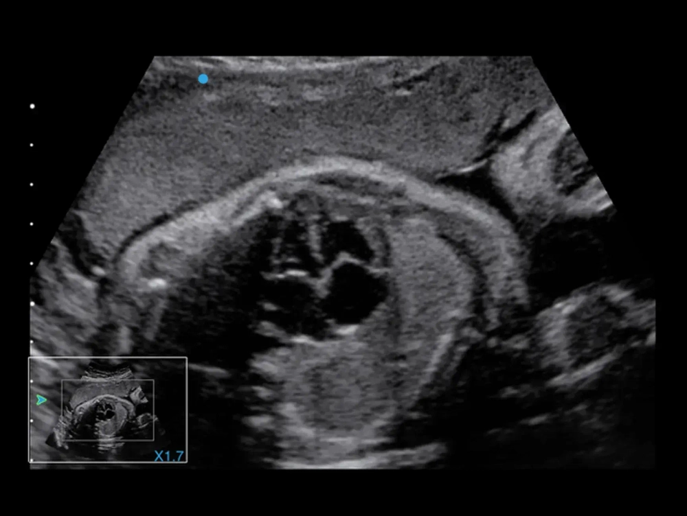 Аппарат УЗИ SIUI Apogee 5500 Exp
