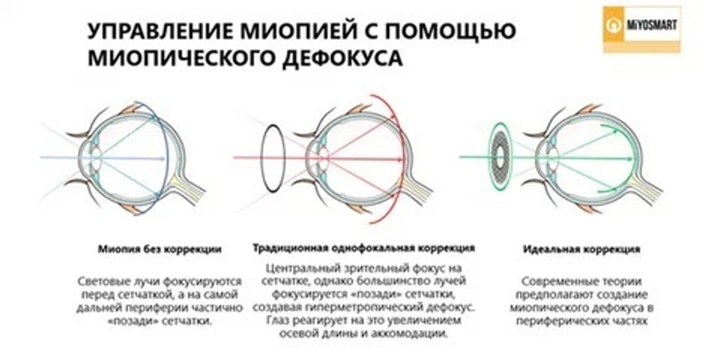 Как работают линзы для контроля миопии