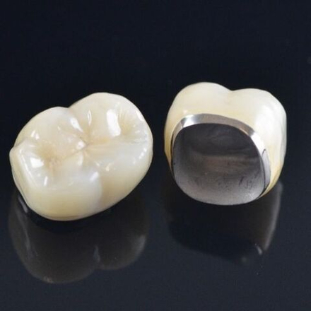 Коронка из металлокерамики