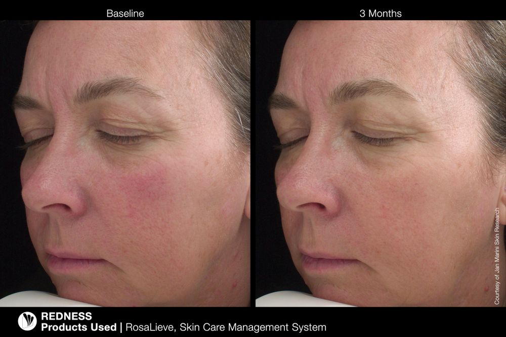 JAN MARINI ROSALIEVE Крем-акселератор для комплексного решения проблем розацеа