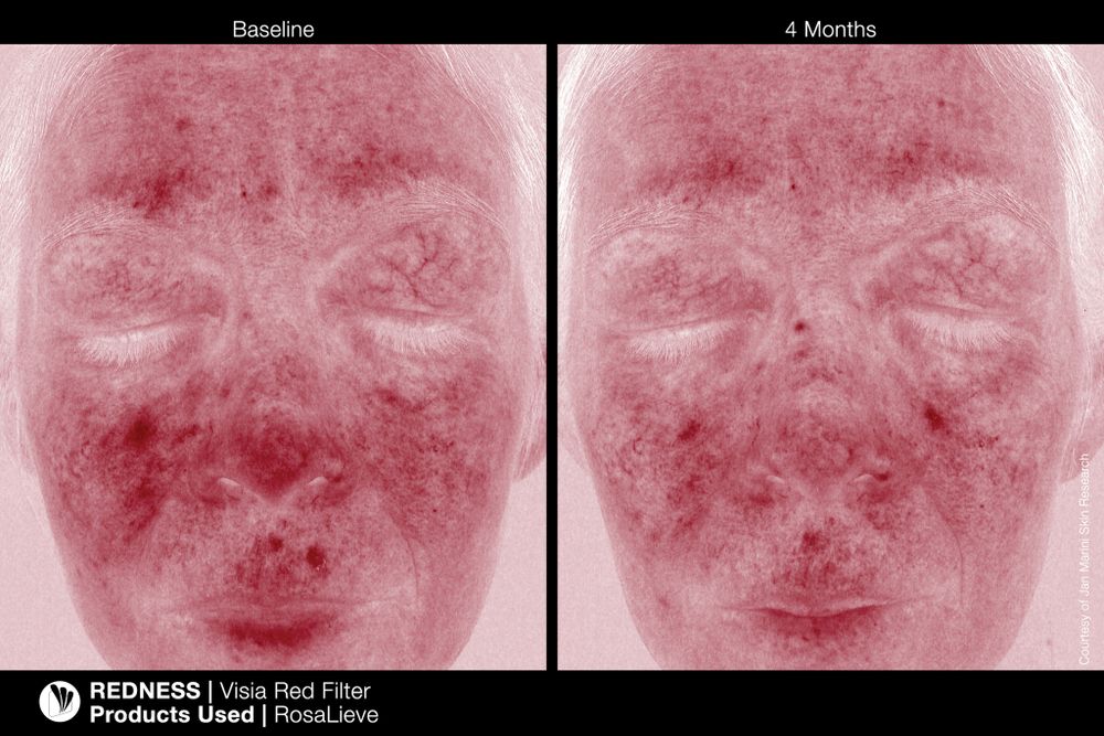 JAN MARINI ROSALIEVE Крем-акселератор для комплексного решения проблем розацеа