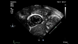 Аппарат УЗИ Philips Epiq 7