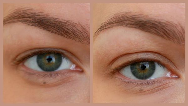 Лифтинг век: Как вернуть открытый взгляд и избавиться от нависшего века Лифтинг век: Как вернуть открытый взгляд и избавиться от нависшего века