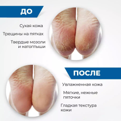 Увлажняющие носочки для пяток с гелевым слоем: увлажнение, смягчение и заживление трещин