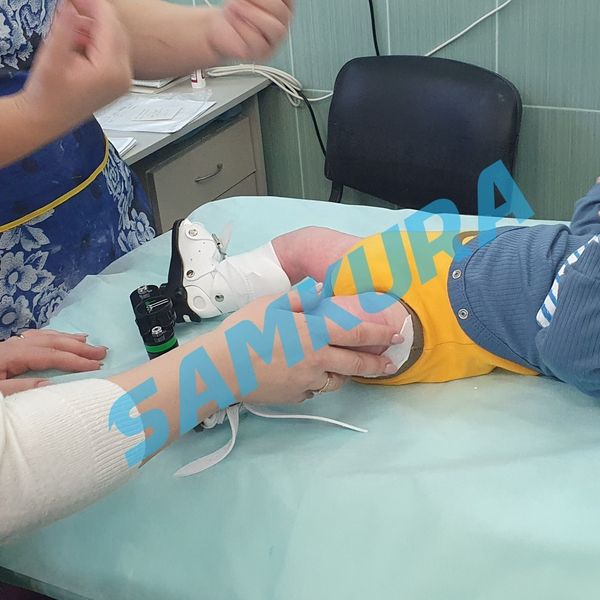 Лечение косолапости по методу Понсети и брейсы.