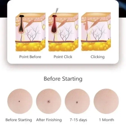 Иголки для лазерной ручки от папиллом и бородавок /10 штук