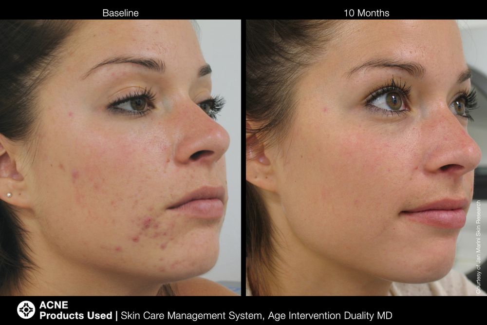 JAN MARINI AGE INTERVENTION DUALITY MD 0,9 % Крем-акселератор с ретинолом 0,9% для решения проблем возрастного акне