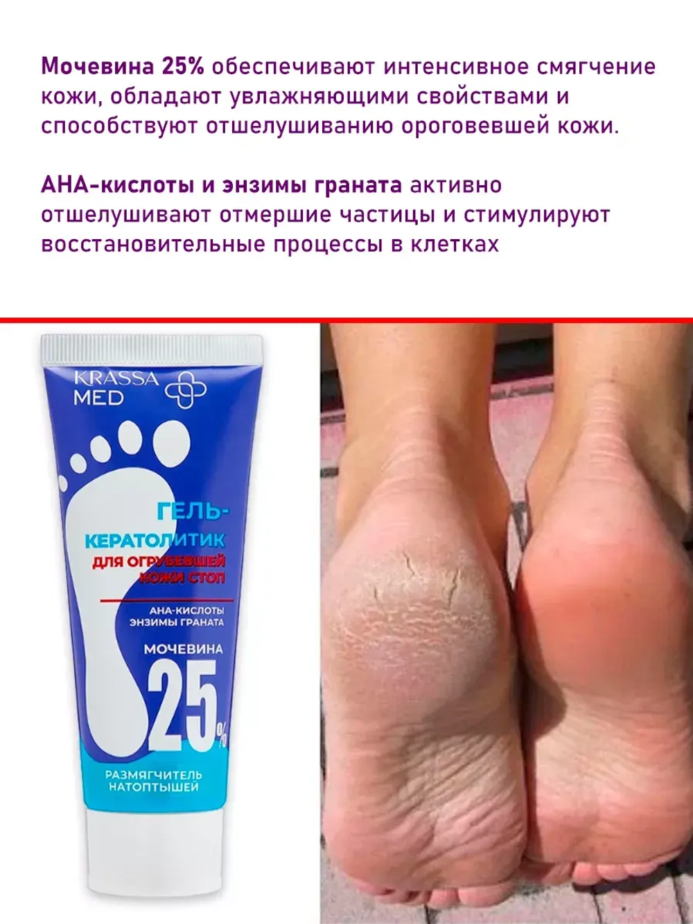 Гель кератолитик для огрубевшей кожи стоп 25%