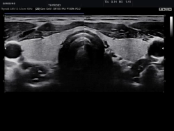 Аппарат УЗИ (сканер) Samsung Medison HS30