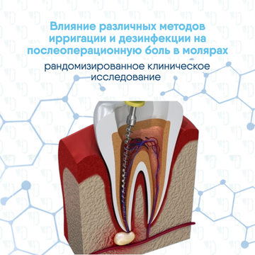 Влияние различных методов ирригации и дезинфекции на послеоперационную боль в молярах нижней челюсти: рандомизированное клиническое исследование