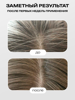 Cosmex Anti-dandruff serum Сыворотка концентрат против перхоти 50 ml с распылителем