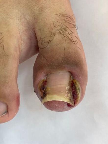 Воспалённый ногть