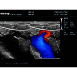 Аппарат УЗИ (сканер) Mindray DC-70