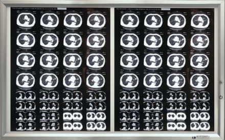 Негатоскопы