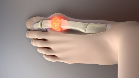 Подагра. Как избежать осложнений?