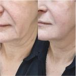 In-AC+Zn Ampoule Eldermafill | Жидкие нити