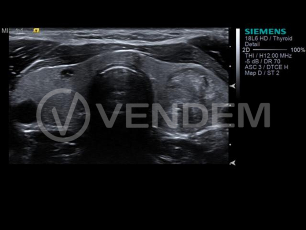 Аппарат УЗИ (сканер) Siemens Healthineers Acuson S3000