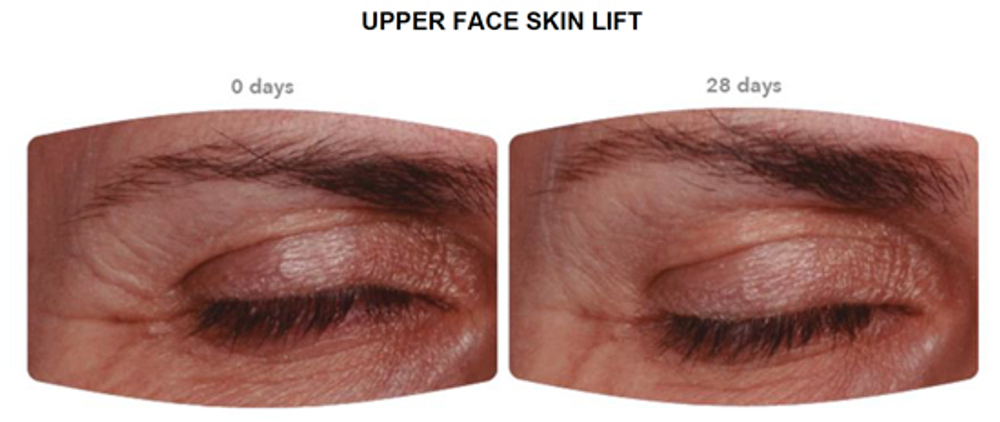 Uplevity™ e-Lift (Аплевити Е-Лифт)