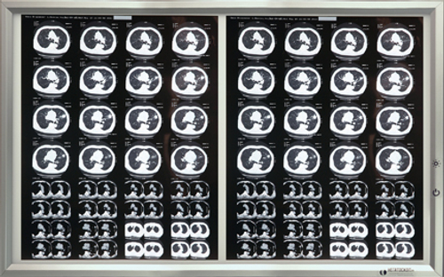 Негатоскоп на 2 снимка медицинский светодиодный