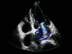 Аппарат УЗИ SIUI Apogee 5500 Exp