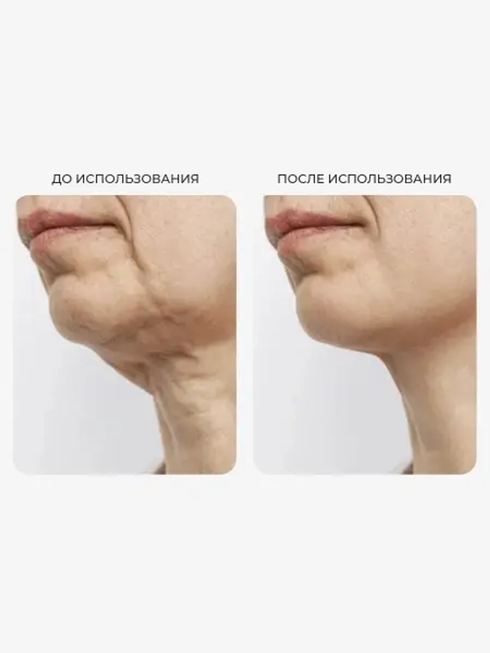 Эластичная маска для подтяжки и укрепления нижней трети лица AROCELL Botoki V Mask