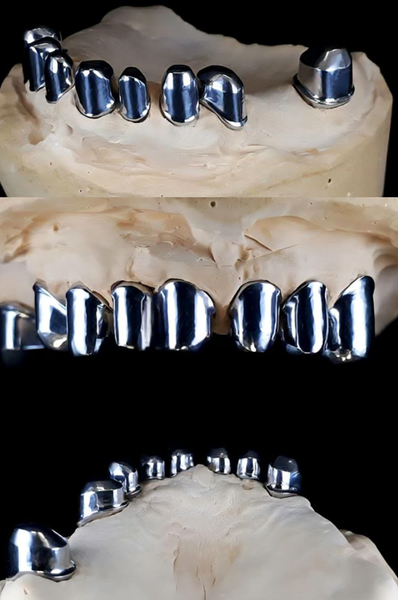 Замковые крепления в бюгельных протезах