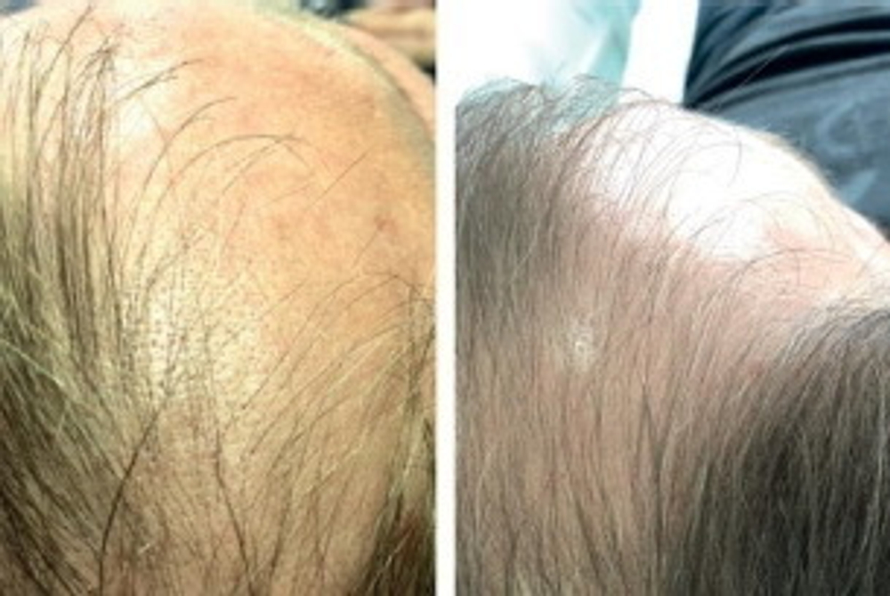 Hair Forest Ampoule Eldermafill | Восстановление волос