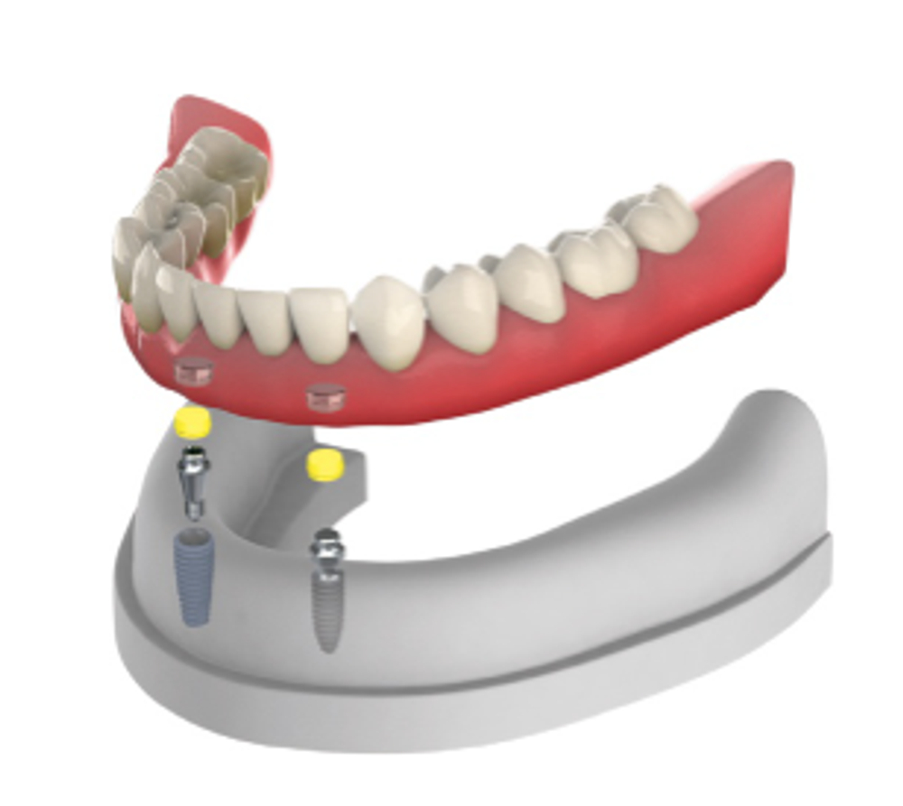 Локаторы DENTIS