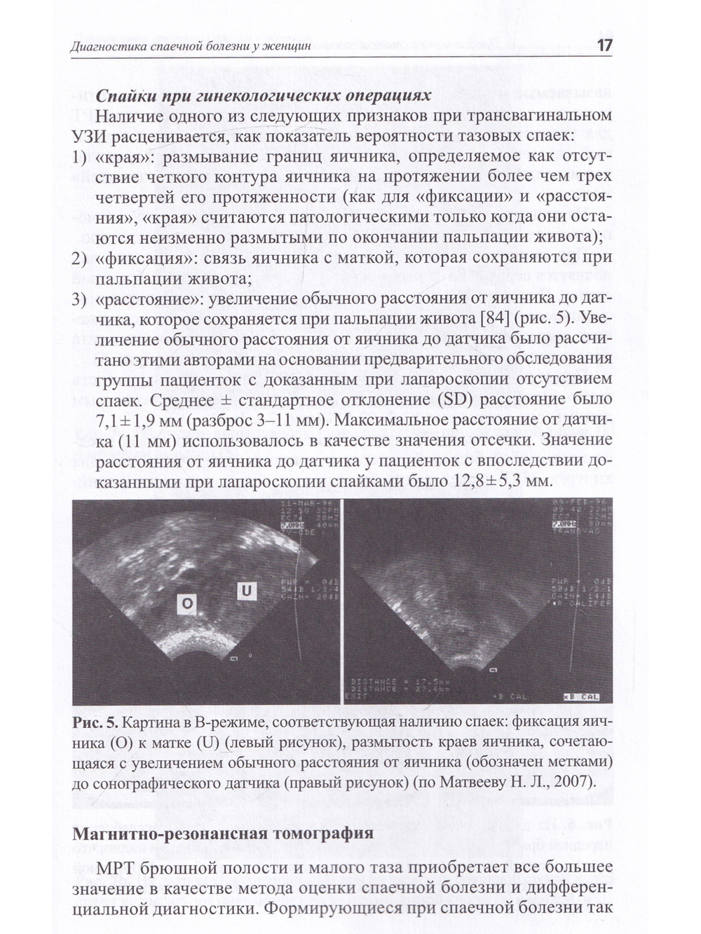Профилактика спайкообразования при операциях на органах малого таза: Пособие для врачей