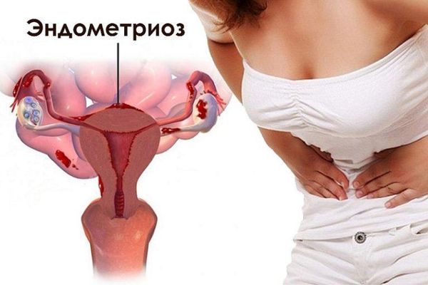 Как лечить эндометриоз? Как лечить эндометриоз?