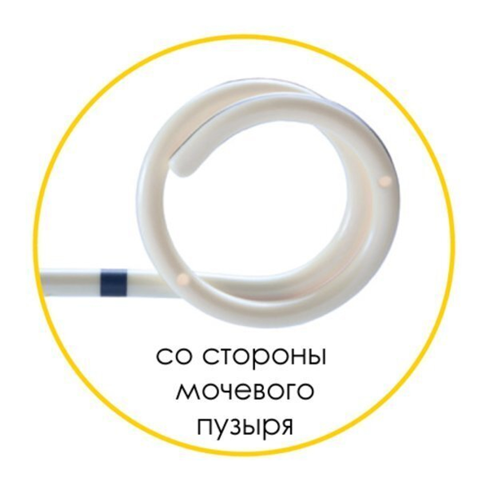 Мочеточниковый стент Urotech White Star набор, двойной завиток, открытый тип, проводник