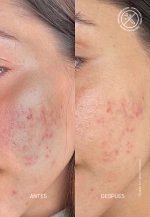 Сыворотка Theramid Azid с азелаиновой кислотой