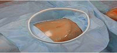 Простыня для кесарева сечения 2,0 ⨯ 1,4 м с карманом и отводом стерильная Инмедиз