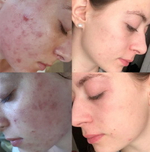 PDRN Booster Eldermafill | Усилитель мезотерапии