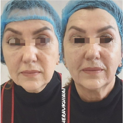 In-AC+Zn Ampoule Eldermafill | Жидкие нити