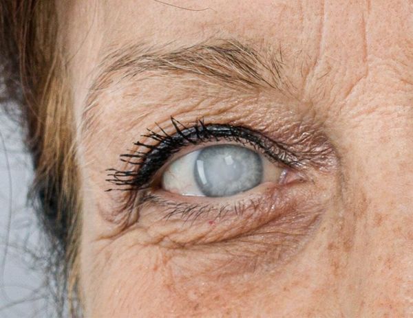 Диабетическая офтальмопатия. Часть 2 (катаракта).