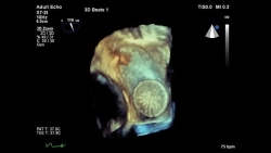 Аппарат УЗИ Philips Epiq 7