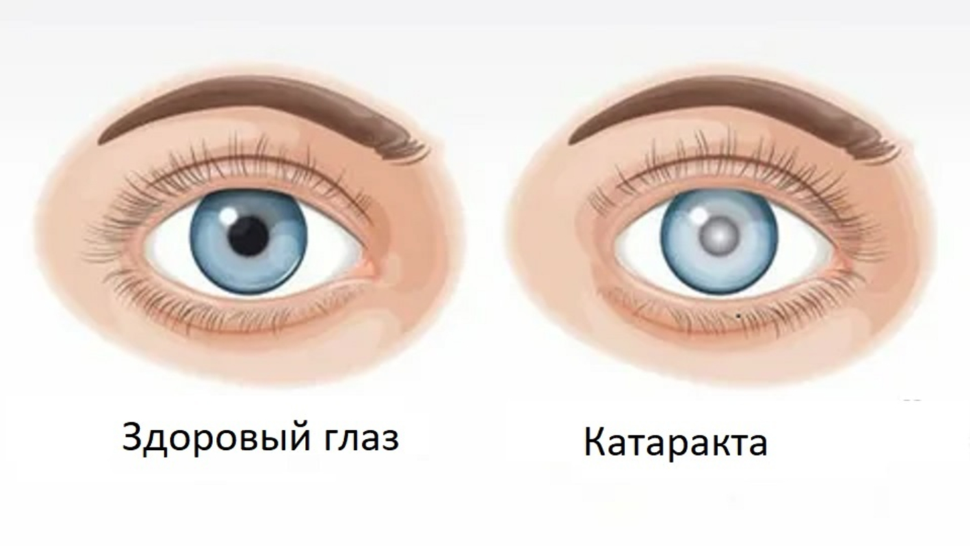 Почему перед подбором очков при катаракте необходимо посетить офтальмолога?