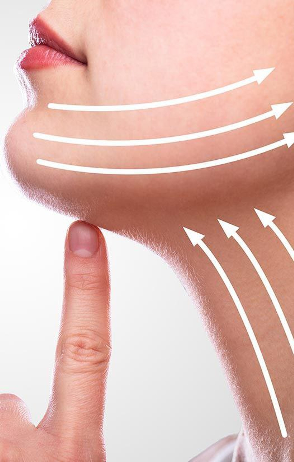 Французский лифтинг