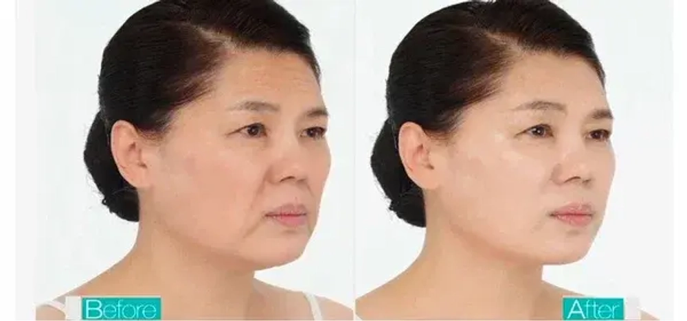 Yu.R Лифтинг комплекс для лица на основе нитевых масок - Thread Lifting Mask (гель+10 масок), 1 шт
