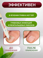 Эффективный крем от ногтевого грибка и микозов купить в Казахстане