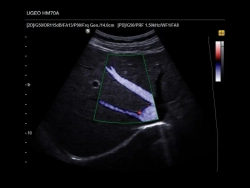 Аппарат УЗИ (сканер) Samsung Medison HM70